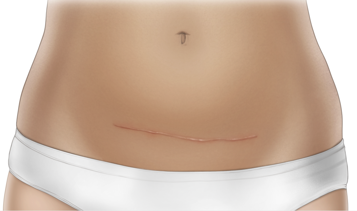 Illustration: Fresh scar after a C-section